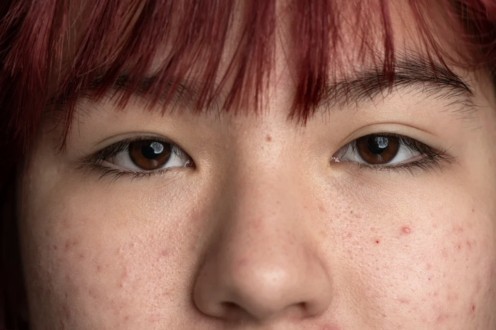 انواع لک پوستی و راه های تشخیص و درمان آن